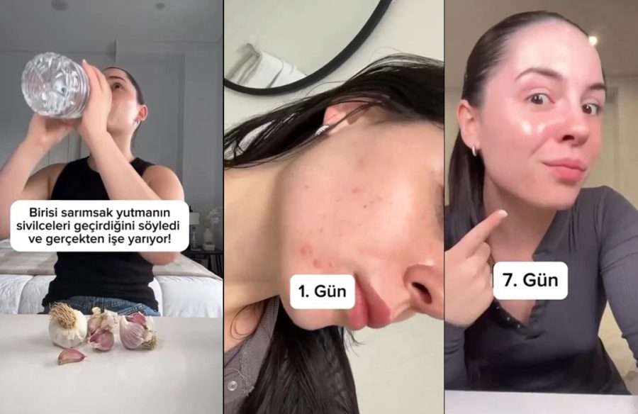 Sarımsak yutmak sivilcelere iyi gelir mi? Sosyal medya sivilcelere çare olacak sarımsak videosunu konuşuyor 2